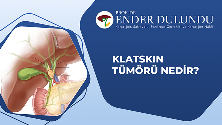 Klatskin Tümörü Nedir?