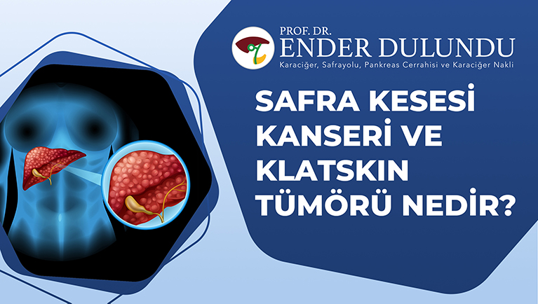 Safra Yolu Kanseri ve Klatskın Tümörü Nedir?