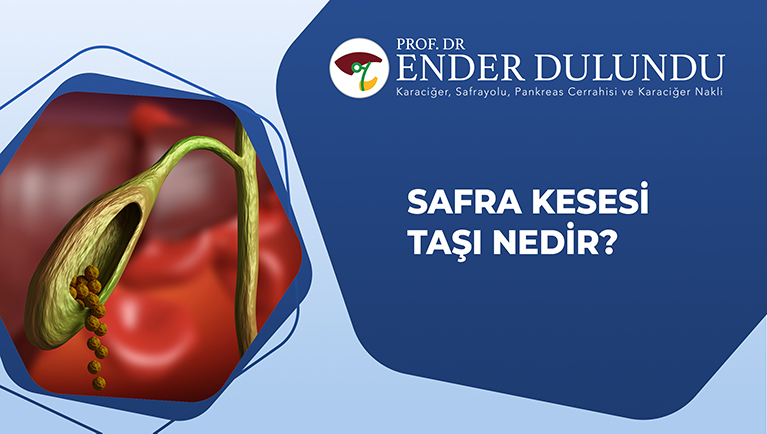 Safra Kesesi Taşı Nedir?